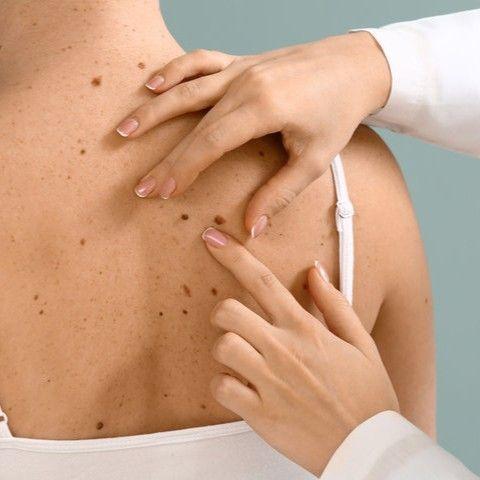 Wideodermatoskopia + konsultacja dermatologa