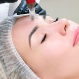 Microneedling of the facial skin