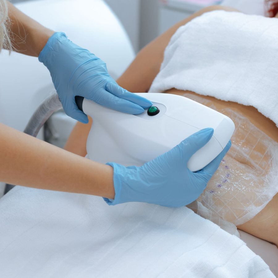 Cryolipolysis 4 head applications - large area