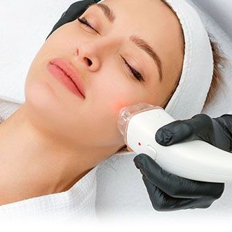 Laser Nd:Yag - usuwanie naczyń na policzkach