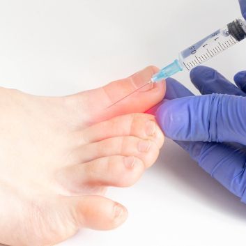 Botulinum toxin - treatment of hyperhidrosis of the feet